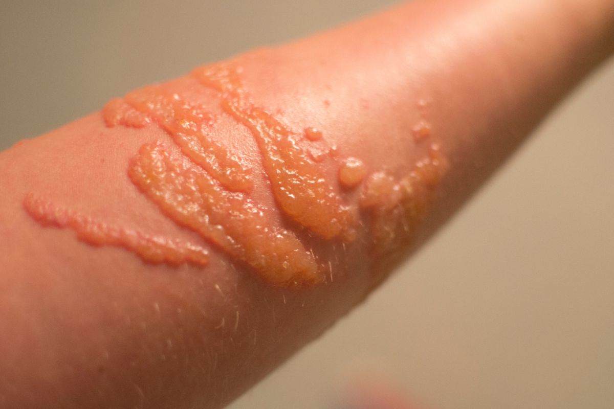 braccio con ustione per contatto con medusa